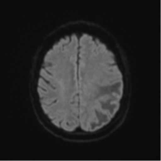 Cerebral metastasis (Radiopaedia 46744-51248 Axial DWI 48).png