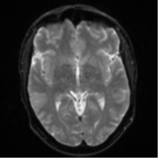 Cerebral metastasis - colorectal adenocarcinoma (Radiopaedia 50394-55765 Axial DWI 12).png