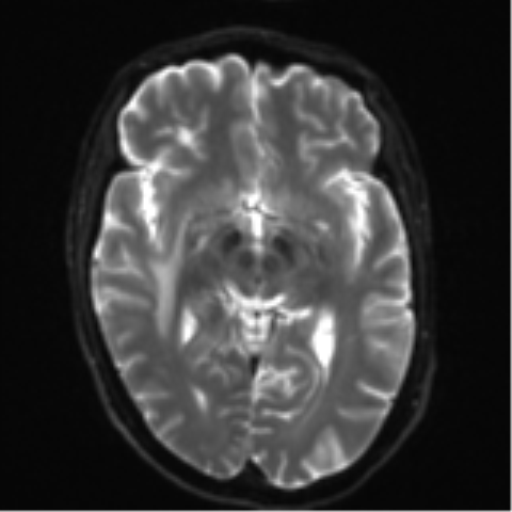Cerebral metastasis - melanoma (Radiopaedia 54718-60954 Axial DWI 14).png