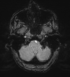 Cerebral metastasis - melanoma (Radiopaedia 54718-60954 Axial SWI 7).png