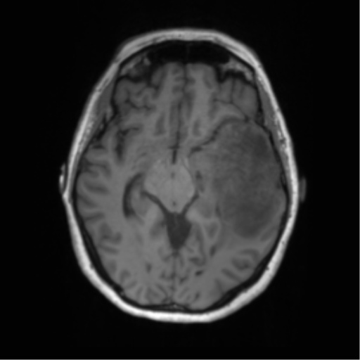 Cerebral metastasis mimicking glioblastoma (Radiopaedia 69155-78937 Axial T1 26).png