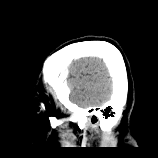 Cerebral metastasis to basal ganglia (Radiopaedia 81568-95412 Sagittal C+ delayed 49).png