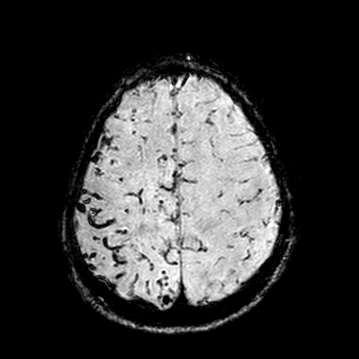 Cerebral parenchymal arteriovenous malformation (Radiopaedia 27280-27456 Axial SWI 96).jpg