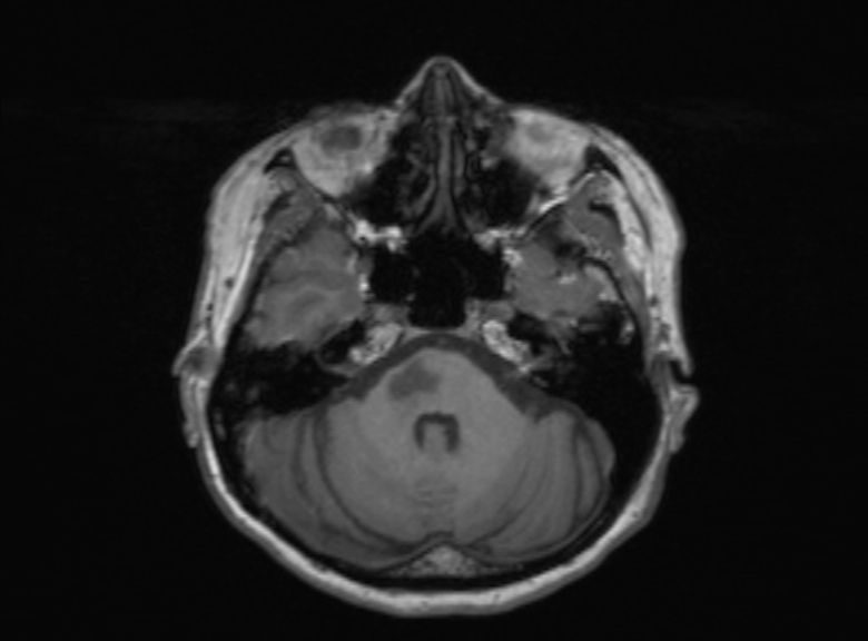 Cerebral ring enhancing lesions - cerebral metastases (Radiopaedia 44922-48817 Axial T1 297).jpg