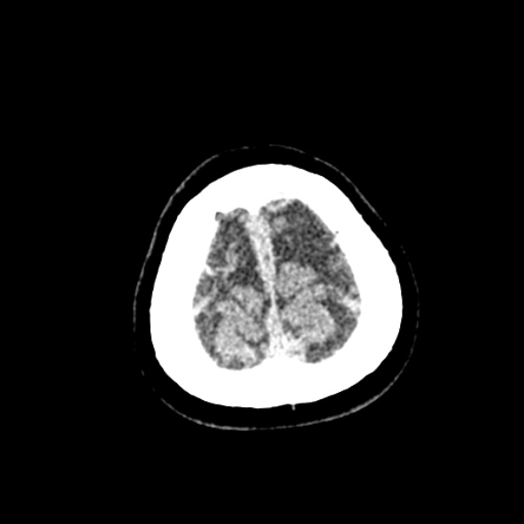 Cerebral ring enhancing lesions - cerebral metastases (Radiopaedia 44922-48818 Axial non-contrast 96).jpg