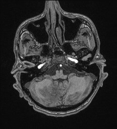 File:Cerebral toxoplasmosis (Radiopaedia 43956-47461 Axial T1 14).jpg