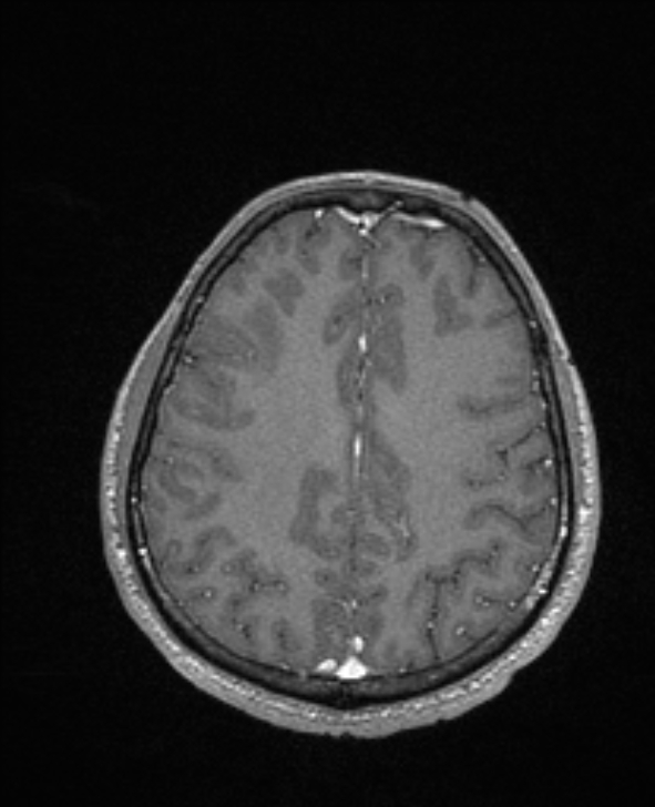 Cerebral toxoplasmosis (Radiopaedia 85779-101597 Axial T1 C+ 118).jpg