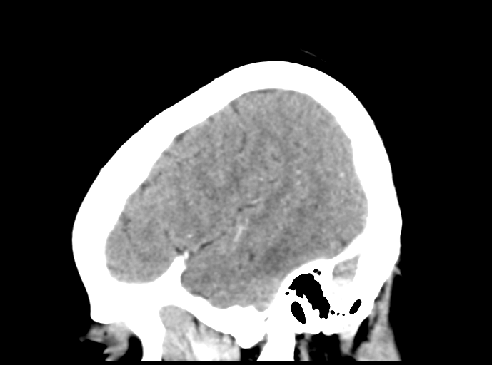 Cerebral venous hemorrhagic infarction (Radiopaedia 57576-64538 Sagittal C+ 43).png