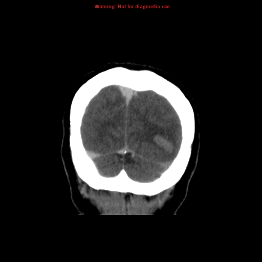 Cerebral venous infarction (Radiopaedia 12404-20735 B 75).jpg