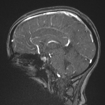 Cerebral venous infarction - hemorrhagic (Radiopaedia 81625-95505 Sagittal MRV 41).jpg