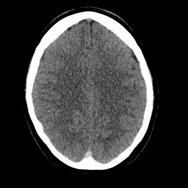 Cerebral venous sinus thrombosis (Radiopaedia 59224-66551 Axial non-contrast 26).jpg