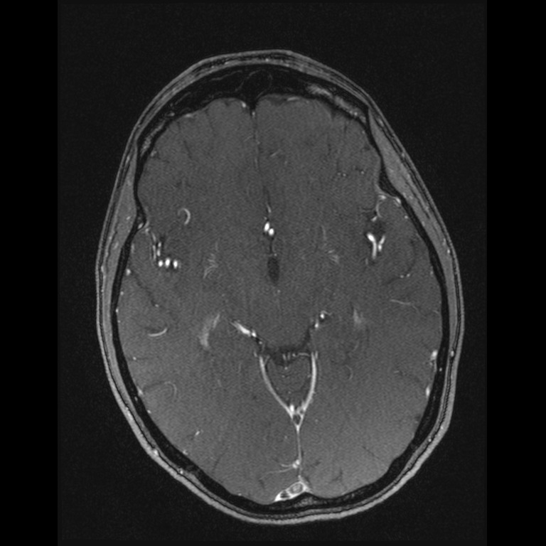 Cerebral venous thrombosis (Radiopaedia 45678-49854 Axial MRV 32).jpg
