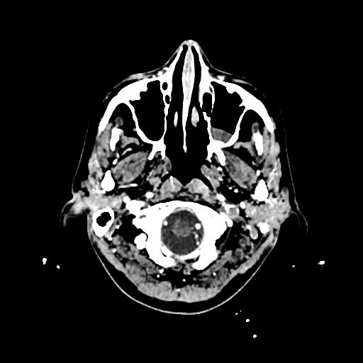 Cerebral venous thrombosis with venous hemorrhagic infarct (Radiopaedia 90354-107660 Axial with contrast 14).jpg
