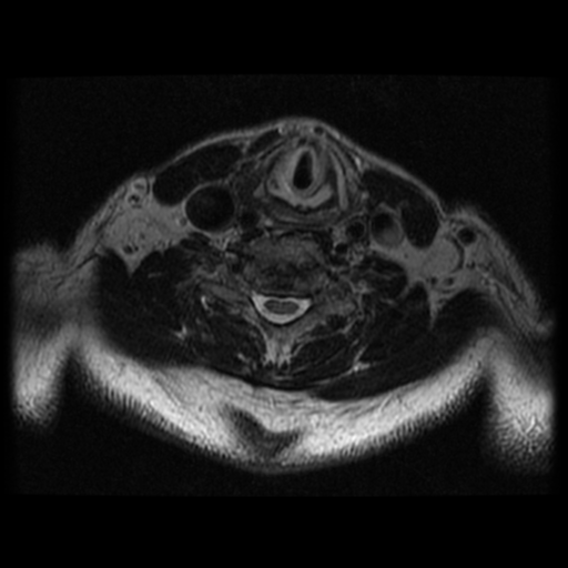 File:Cervical canal stenosis with cord compression (Radiopaedia 34114-35374 Axial T2 17).png