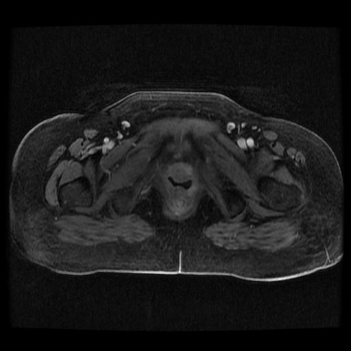 Cervical carcinoma (Radiopaedia 70924-81132 Axial T1 C+ fat sat 203).jpg
