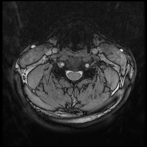 Cervical disc extrusion (Radiopaedia 59074-66364 G 44).jpg