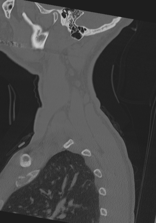 Cervical intercalary bone (Radiopaedia 35211-36748 Sagittal bone window 75).png
