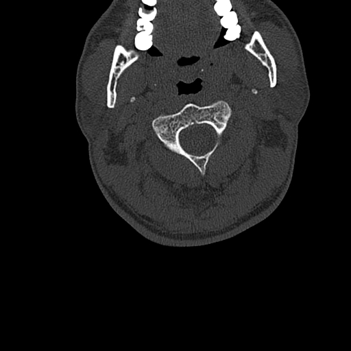 File:Cervical spine trauma with tear drop fracture and perched facet joint (Radiopaedia 53989-60127 Axial bone window 35).jpg