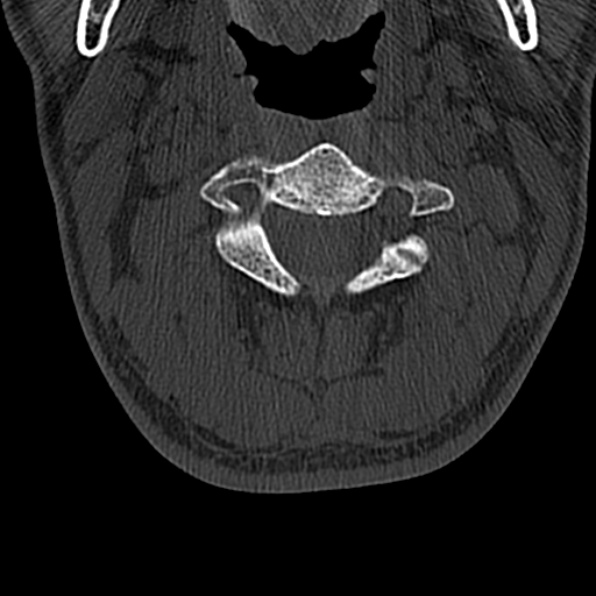 Cervical spondylodiscitis (Radiopaedia 28057-29489 Axial bone window 28).jpg