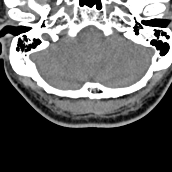 Cervical spondylodiscitis (Radiopaedia 28057-29489 Axial non-contrast 6).jpg