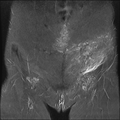 File:Cesarian section scar endometriosis (Radiopaedia 66520-75799 Coronal STIR 4).jpg