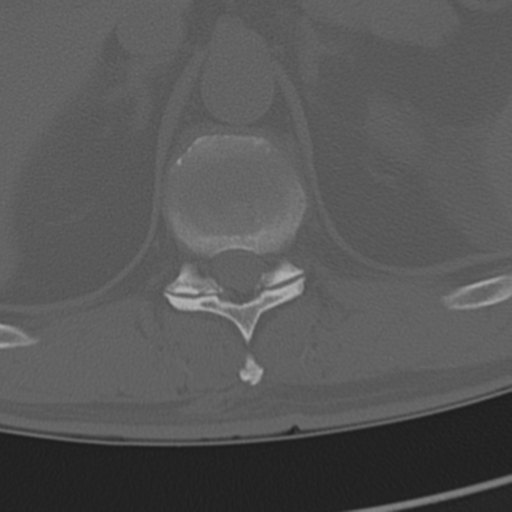 Chance fracture (Radiopaedia 33854-35020 Axial bone window 82).png