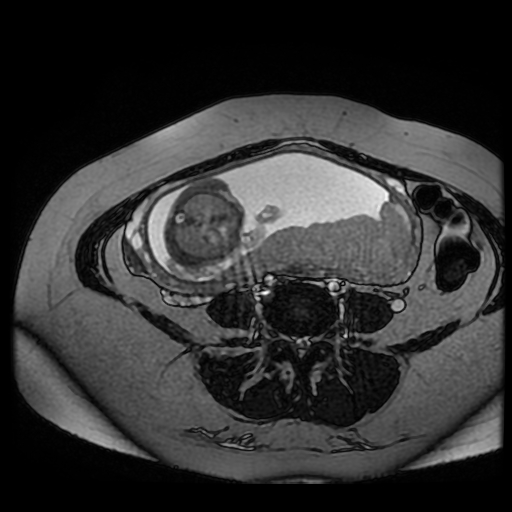 Chiari II malformation - fetal MRI (Radiopaedia 68099-77581 Axial Fiesta 22).jpg