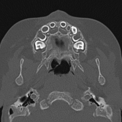 Choanal atresia (Radiopaedia 88525-105975 Axial bone window 9).jpg
