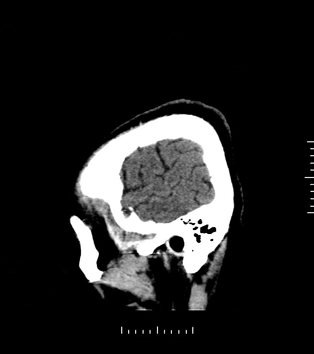 Cholangiocarcinoma with cerebral metastases (Radiopaedia 83519-98628 C 50).jpg