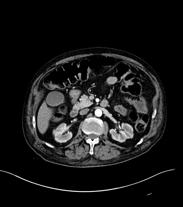 Cholangiocarcinoma with cerebral metastases (Radiopaedia 83519-98629 B 39).jpg