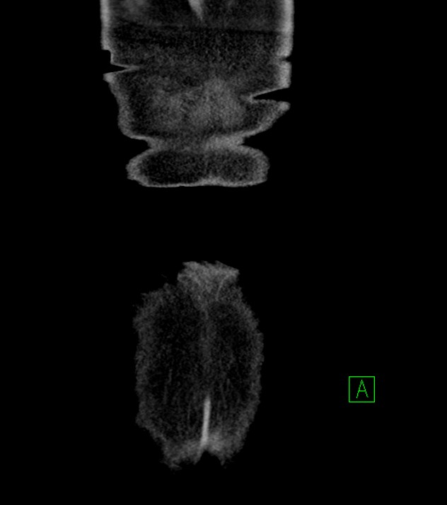 Cholangiocarcinoma with cerebral metastases (Radiopaedia 83519-98629 G 85).jpg