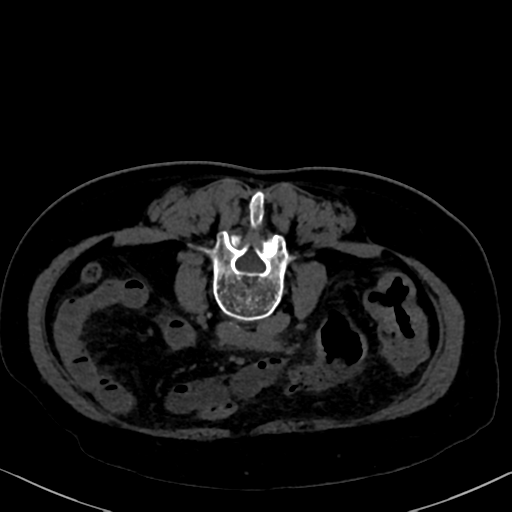 File:Cholecystitis - obstructive choledocholitiasis (CT intravenous cholangiography) (Radiopaedia 43966-47479 Axial 74).png
