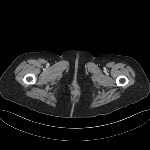 Cholecystoduodenal fistula due to calculous cholecystitis with gallstone migration (Radiopaedia 86875-103077 D 90).jpg