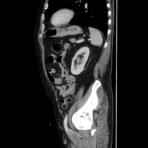 Choledocholiathiasis with normal caliber common bile duct (Radiopaedia 75368-86632 D 115).jpg