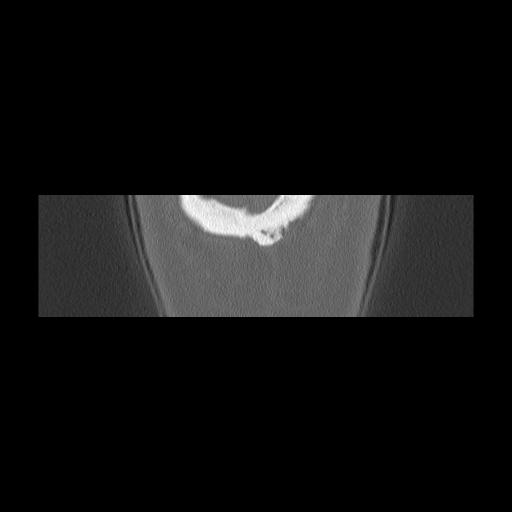 File:Cholesteatoma (Radiopaedia 84946-100455 Coronal bone window 169).jpg