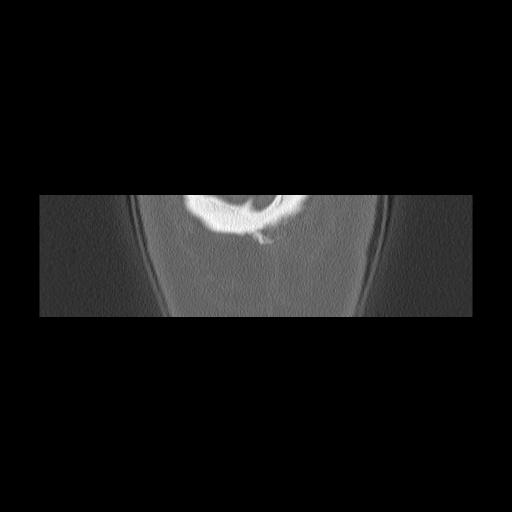 Cholesteatoma (Radiopaedia 84946-100455 Coronal bone window 170).jpg