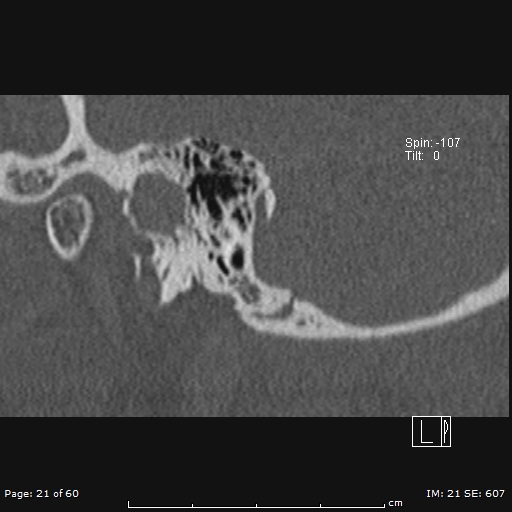 File:Cholesteatoma - external auditory canal (Radiopaedia 88452-105096 Sagittal bone window 21).jpg