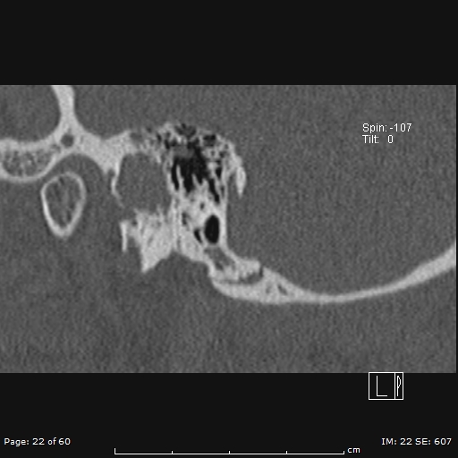 File:Cholesteatoma - external auditory canal (Radiopaedia 88452-105096 Sagittal bone window 22).jpg