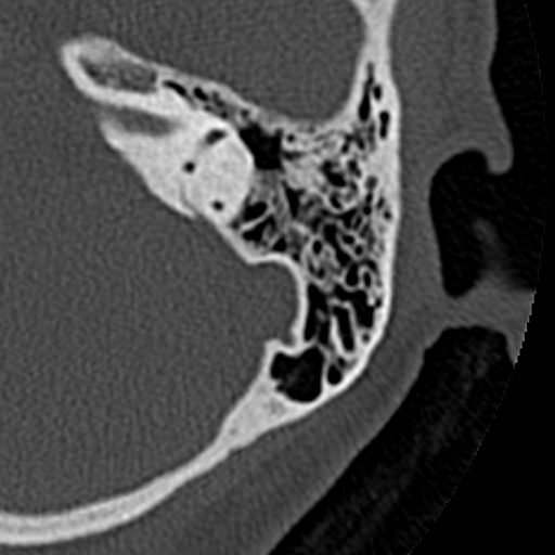 File:Cholesteatoma of the external ear (Radiopaedia 16540-16225 Axial bone window 16).jpg