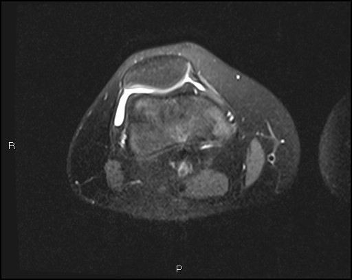 File:Chondroblastoma (Radiopaedia 62721-71031 Axial PD fat sat 11).jpg