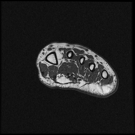 File:Chondroblastoma - midfoot (Radiopaedia 64831-73765 Short axis T1 25).jpg