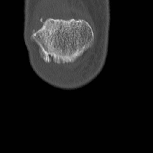 Chondrocalcinosis (Radiopaedia 16275-15955 Coronal bone window 5).jpg