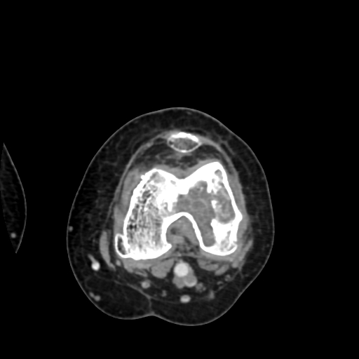 Chondrosarcoma - femur (Radiopaedia 64187-72954 Axial with contrast 49).jpg