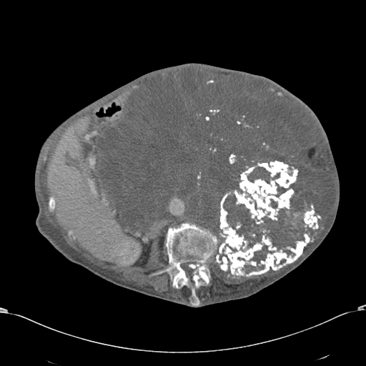 Chondrosarcoma of the spine (Radiopaedia 49871-55143 A 28).jpg