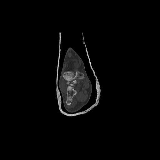 File:Chopart fracture (Radiopaedia 12386-12650 Coronal bone window 7).jpg