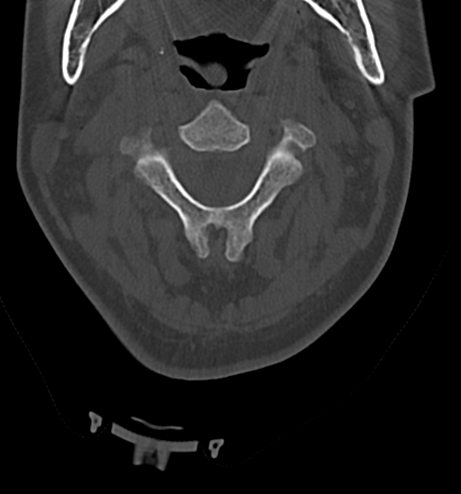 File:Chordoma (C4 vertebra) (Radiopaedia 47561-52188 Axial bone window 15).png