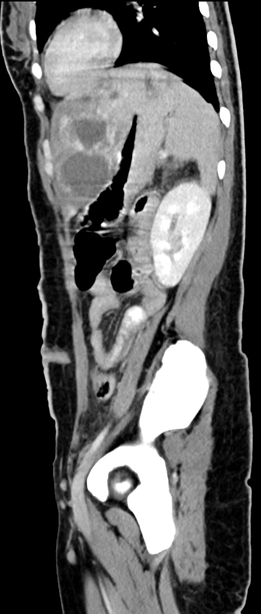 Choriocarcinoma liver metastases (Radiopaedia 74768-85766 C 69).jpg