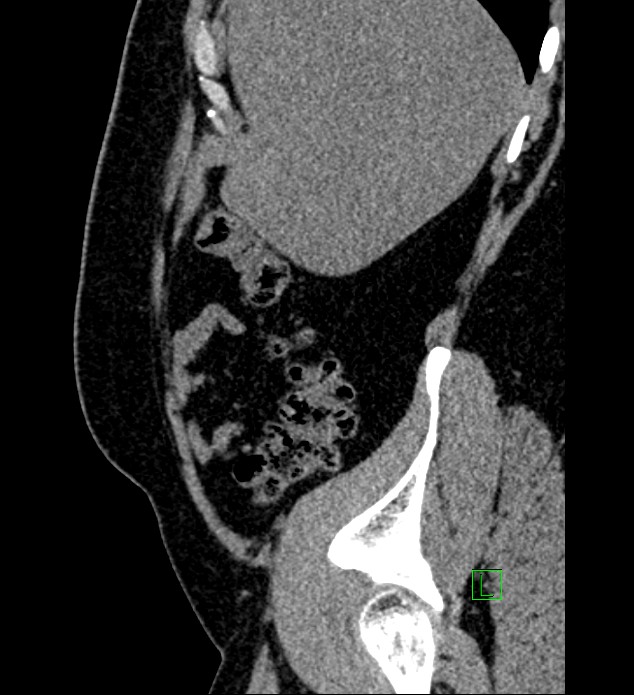 Chromophobe renal cell carcinoma (Radiopaedia 84286-99573 C 154).jpg