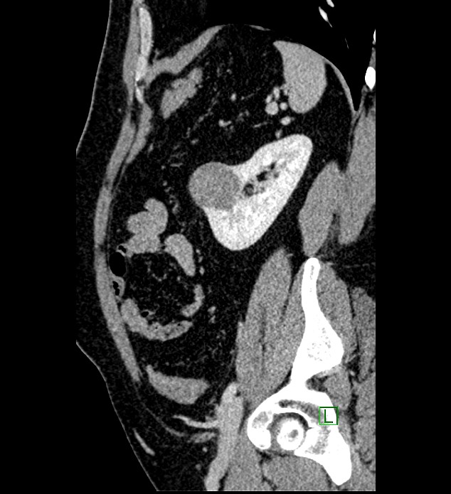 Chromophobe renal cell carcinoma (Radiopaedia 84286-99573 I 49).jpg