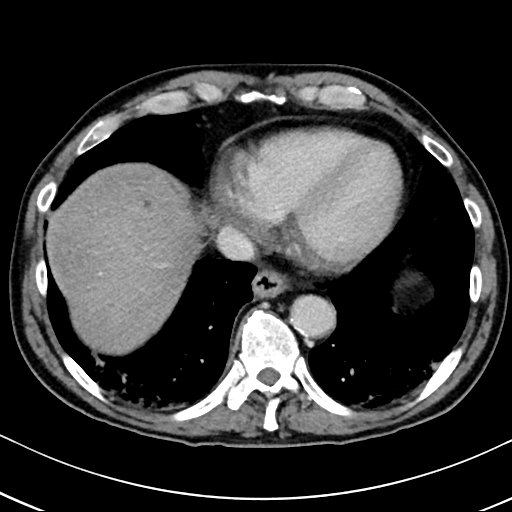 Chronic appendicitis complicated by appendicular abscess, pylephlebitis and liver abscess (Radiopaedia 54483-60700 B 22).jpg